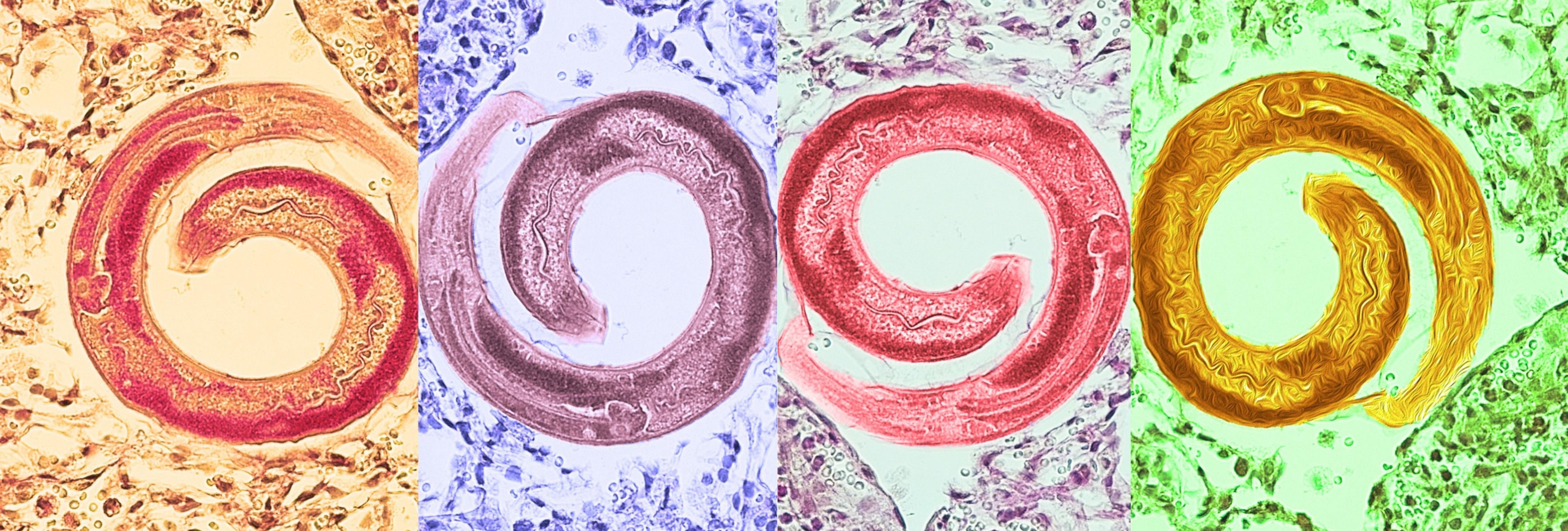 : A roundworm inside lungs shown with four different colors and styles